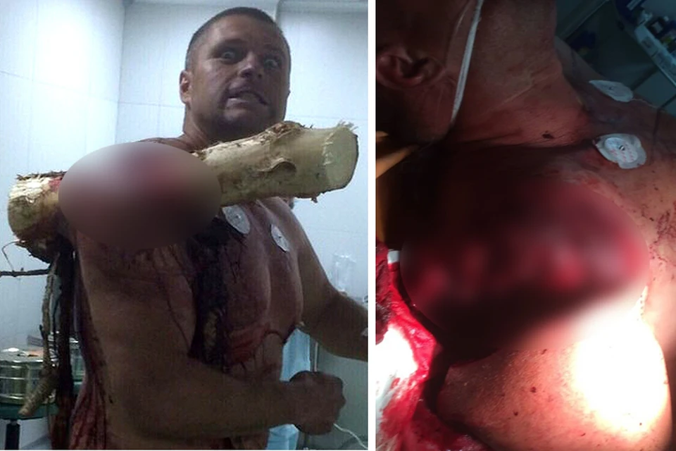 «Я удивился, как он вообще выжил!»: хирург рассказал, как оперировал парня с бревном в плече. Фото: АТН и instagram@akrasilla.