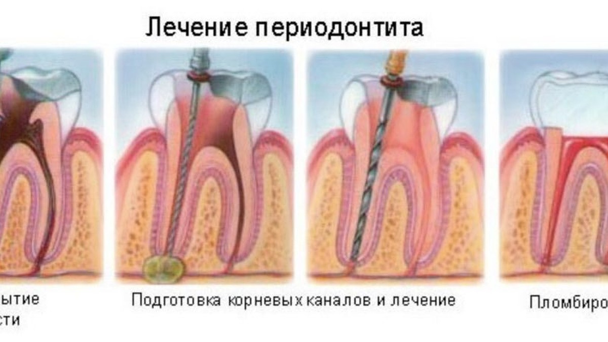 Лечить или удалять? - KP.RU