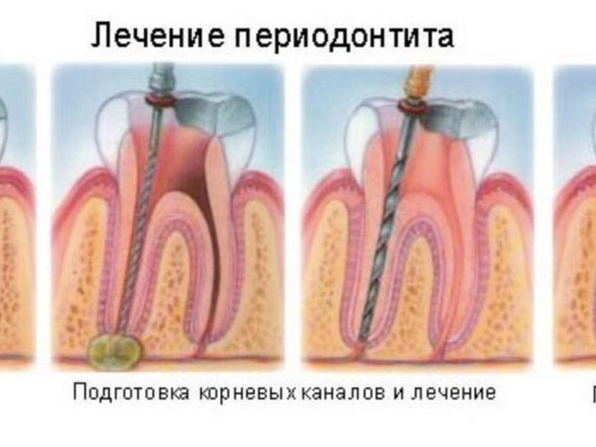 Лечить или удалять? - KP.RU