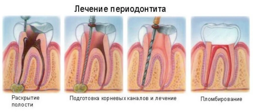 Как выглядит открытый канал зуба Лечить или удалять? - KP.RU