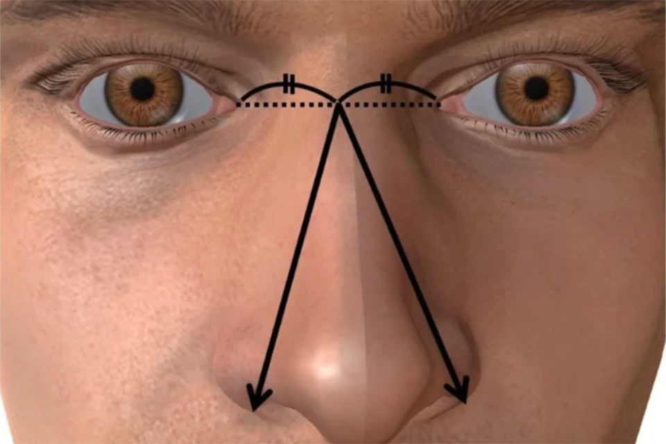 Размер носа определялся как большое расстояние между средней точкой левого и правого медиальных глазных углов и внешней стороной левого или правого крыла носа (указано стрелкой). Фото: bacandrology.biomedcentral.com