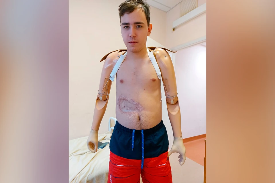 Подростку из Красноярска, лишившемуся рук, установили протезы спустя 6 лет после несчастного случая. Фото: ЦУГЛЕНОК Наталья