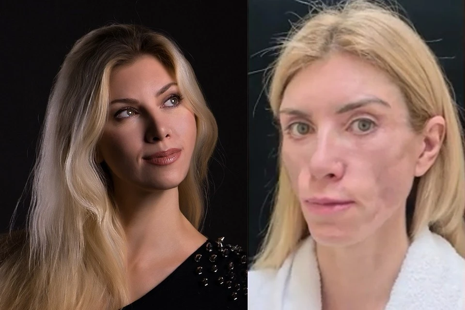 На фото Юлия до операции (слева) и после неудачного вмешательства.