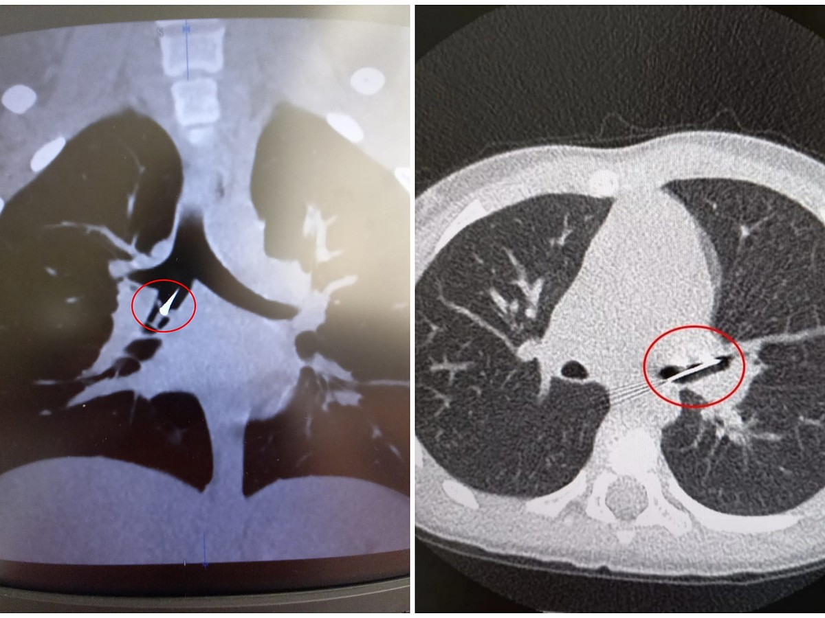 В Челябинской области в бронхах детей нашли иголку и канцелярскую кнопку.  Как они туда попали? - KP.RU