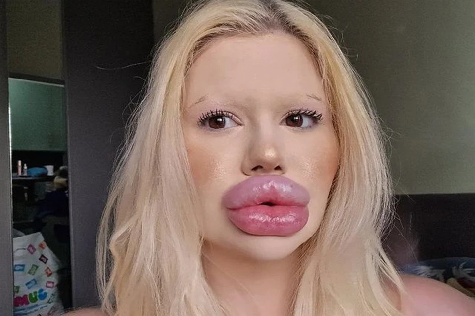 Женщина с самыми большими губами в мире сделала за один день шесть операций на лице, увеличив скулы, подбородок и челюсть