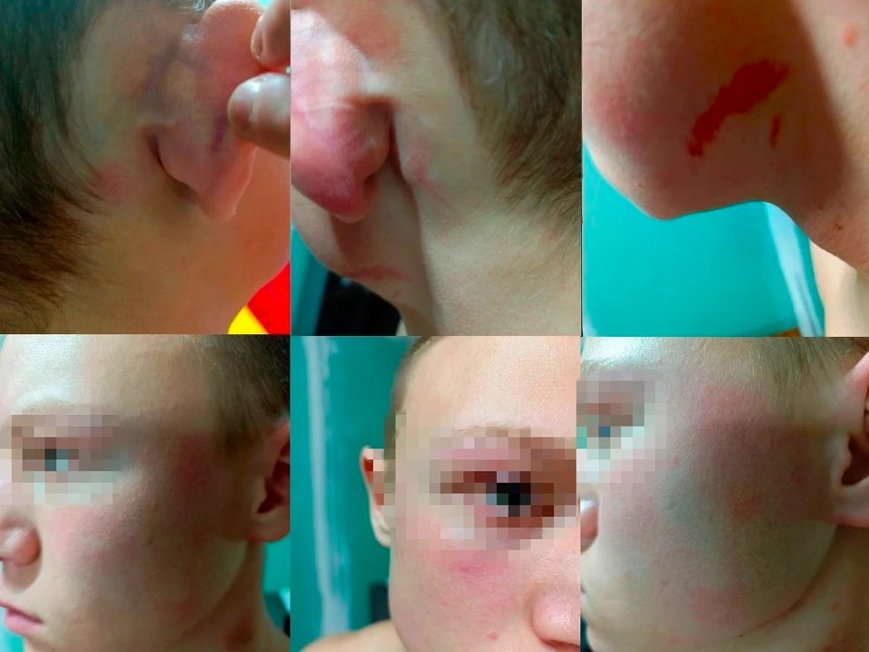 У подростка осталось множество ушибов и гематом на голове. Фото: предоставлено КП-Челябинск