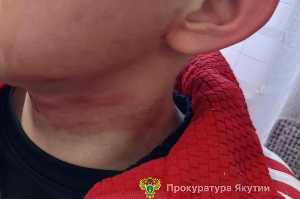 Семья школьника, покусанного собаками в Алдане, получит 200 тысяч рублей. Фото: прокуратура РС (Я)