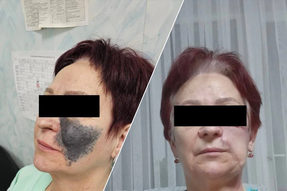 Пенсионерке из Ставрополя удалили опасную для жизни родинку. Фото: больница скорой помощи Ставрополя