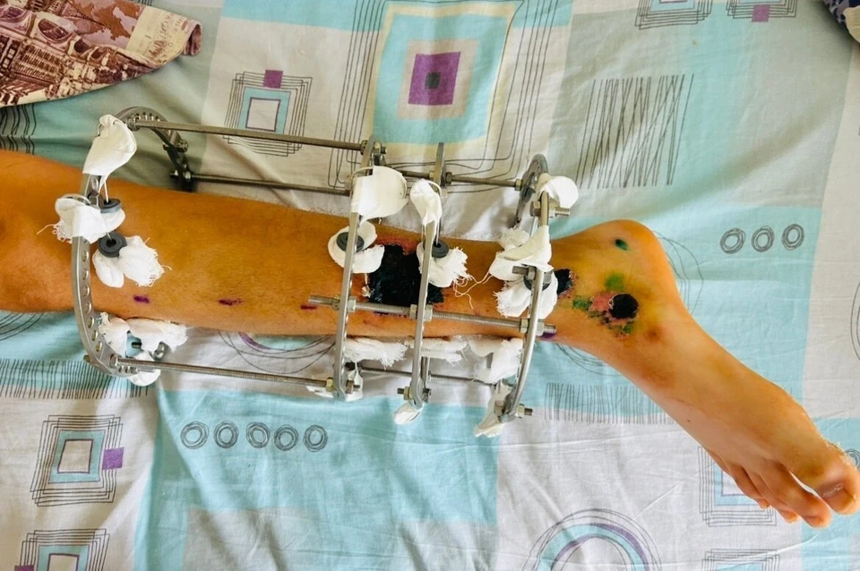 Полный процесс восстановления займет 6 до 8 месяцев. Фото: Тысячекоечная больница