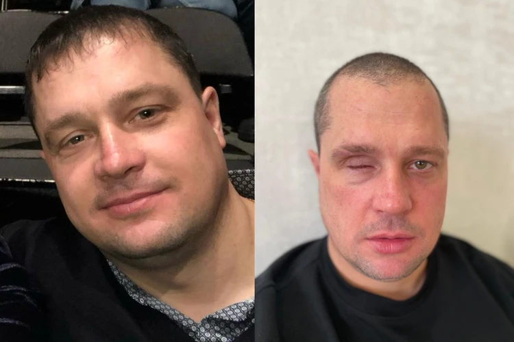 «Я его будил, а он резко вскочил и набросился»: в Новосибирске охранник лишился глаза после драки с пьяным байкером