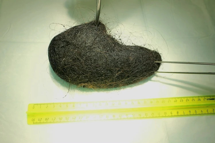 Синдром Рапунцель. В Барнауле у девочки из желудка удалили комок волос весом 400 граммов