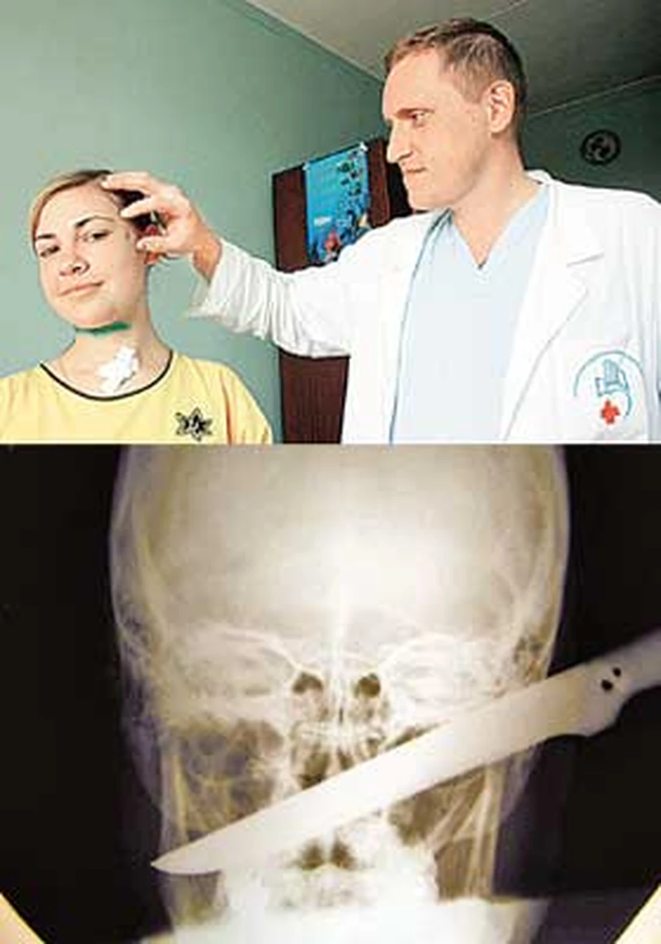 Вверху- врач осматривает Ольгу: удар пришелся как раз в висок. Рентгеновский снимок ножа в голове - внизу.