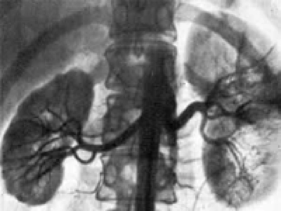 Гипоплазия почки. Гипоплазия правой почки почки рентген. Олигомеганефроническая гипоплазия. Гипоплазия почки рентген. Гипоплазия почечной артерии.