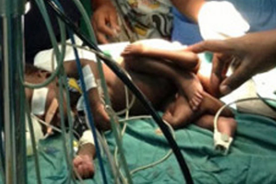 В Уганде родился мальчик, у которого были по четыре ноги и руки