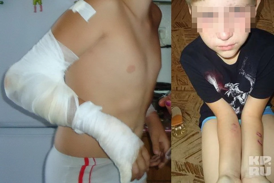 После укусов сенбернара школьник перенес две операции подряд.